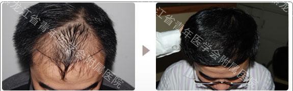 据王斌自己介绍,前段时间突然发现头发掉的很多,刚开始以为是换季的图片
